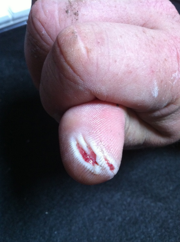Grinder-wounds 01.jpg
